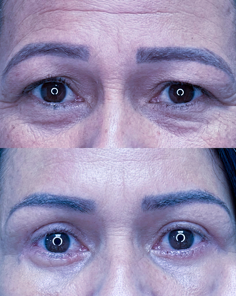 Caso 01 — antes e depois de Blefaroplastia Superior + Ptose