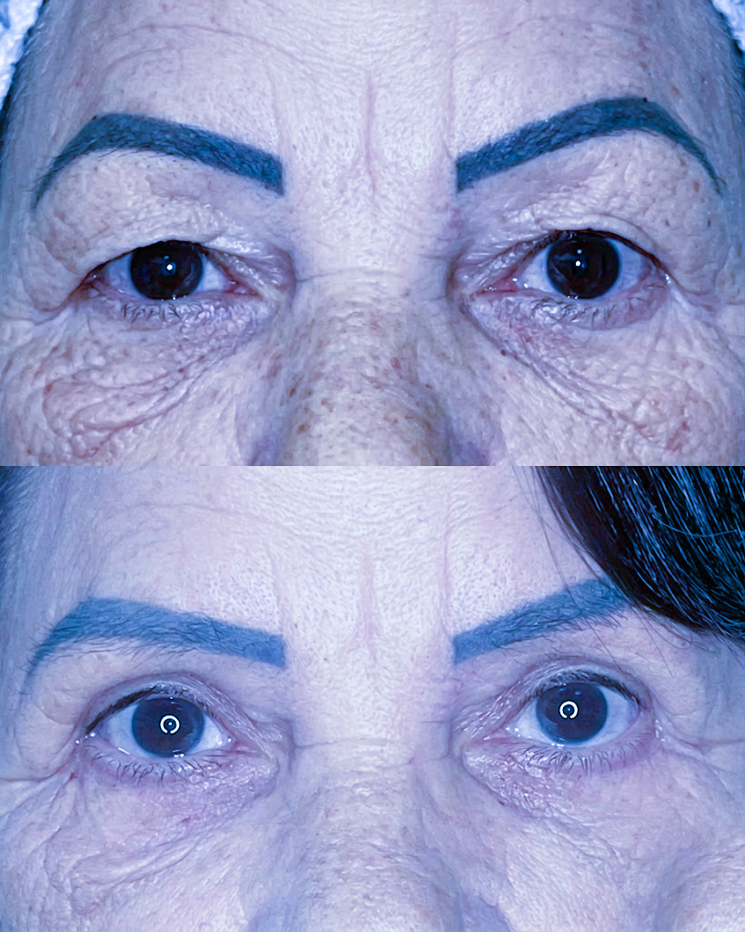 Caso 02 — antes e depois de Blefaroplastia Superior + Inferior