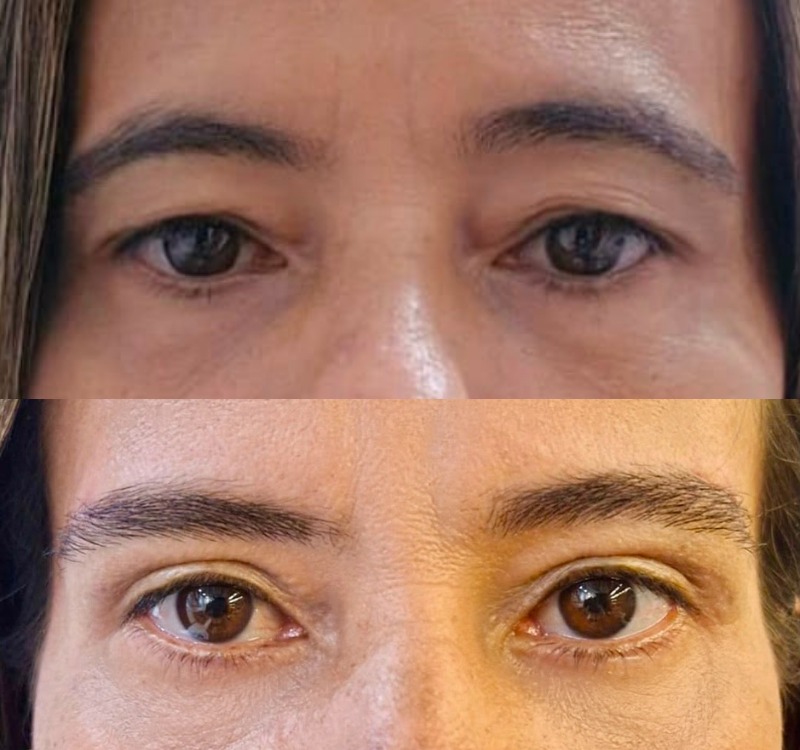 Caso 02 — antes e depois de BLEFAROPLASTIA SUPERIOR +
INFERIOR + LIFT DE SUPERCÍLIO