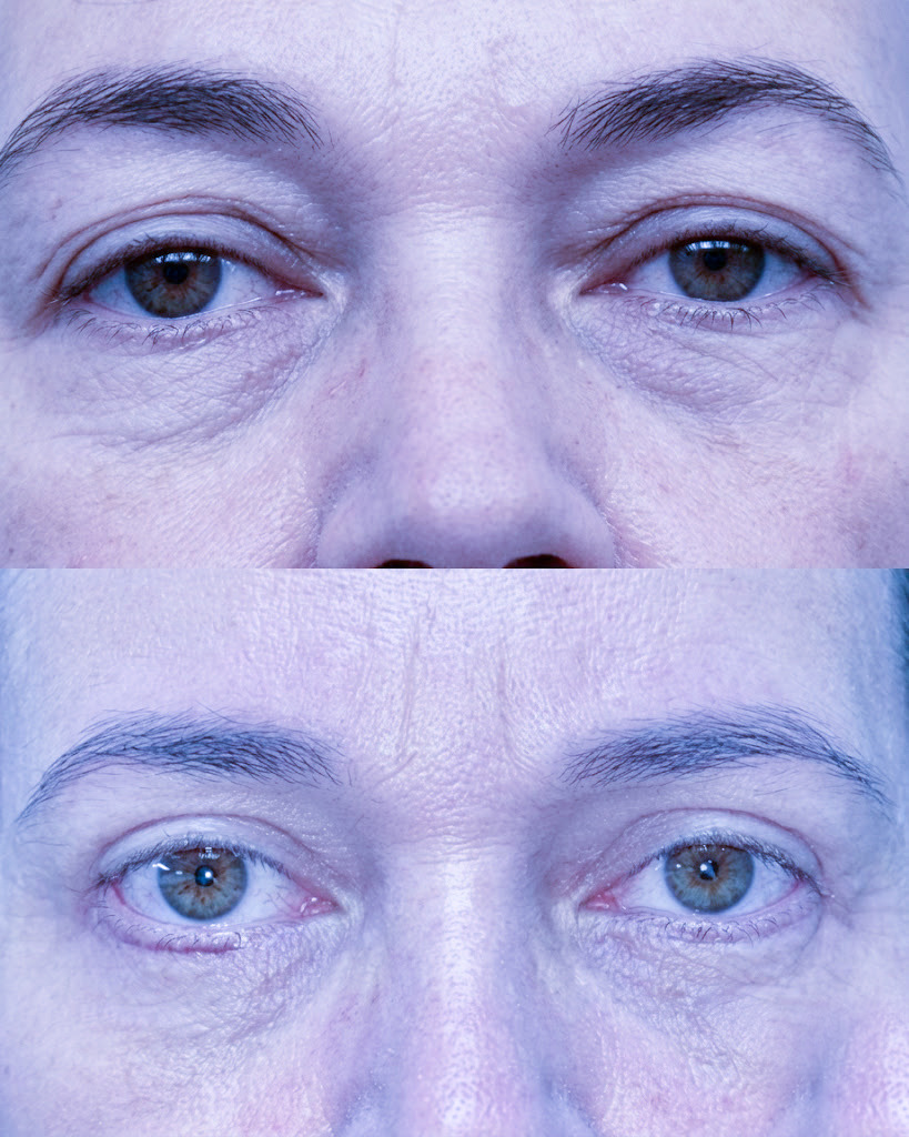 Caso 03 — antes e depois de Blefaroplastia Superior